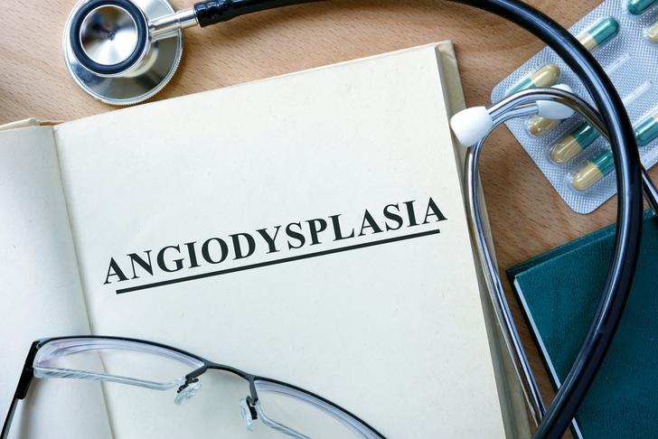 angiodysplasia