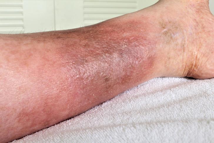 cellulitis