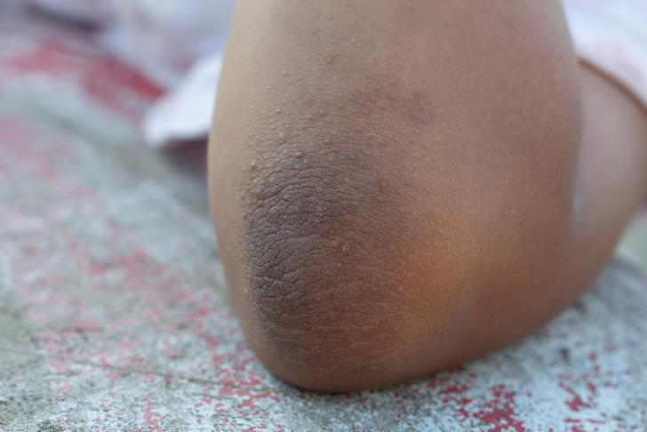 darkened skin-patches