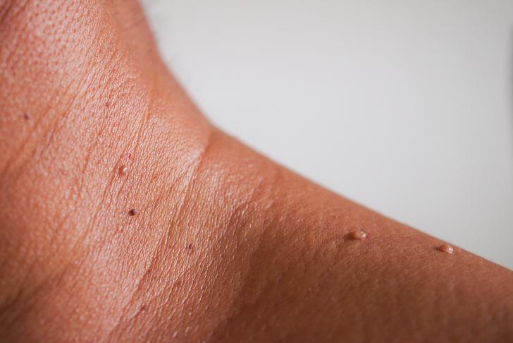 high blood-pressure-skin-tags