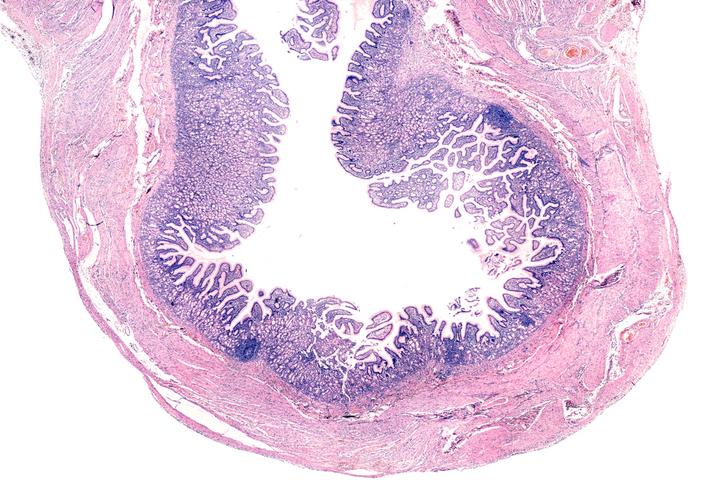 meckels diverticulum