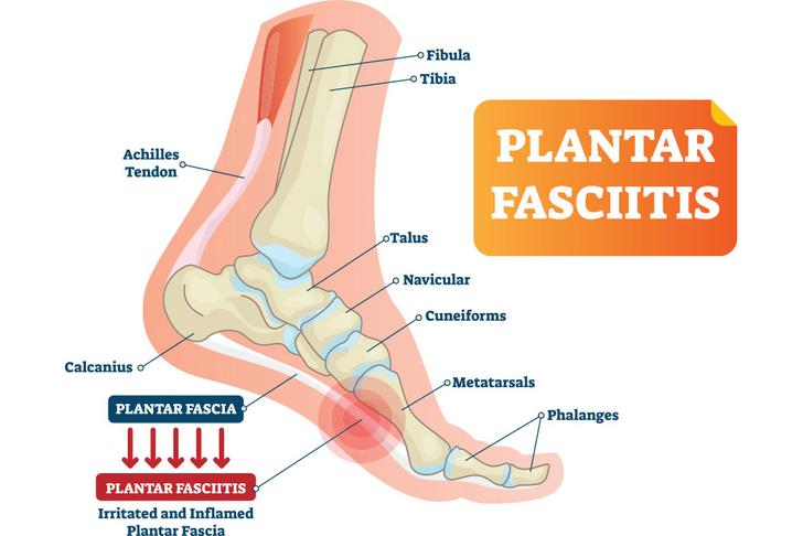 plantar fasciitis