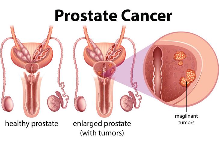 prostate cancer