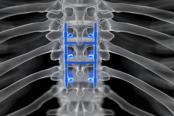 spinal fusion